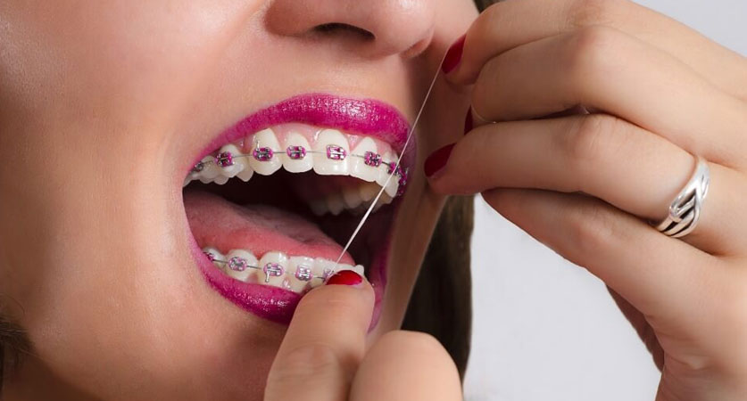 How To Fix Overbite With The Orthodontic Braces?