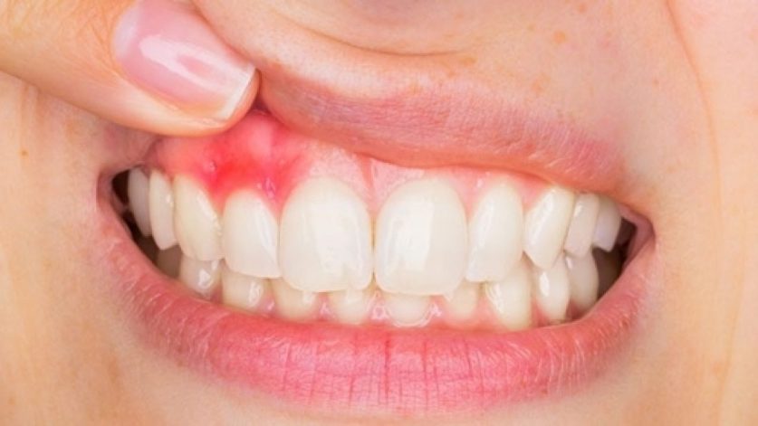 Tooth Abscess What Do You Know About Tooth Abscesses