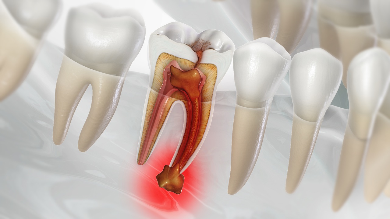 recognizing-the-signs-common-an-abscess-tooth-symptoms